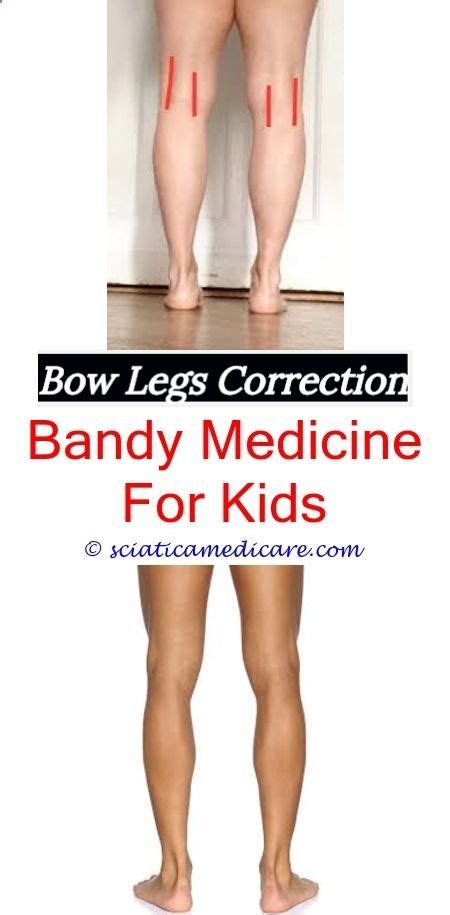 Permanent Remedy For Bow Legs Kids Bowhow To Correct Bow Legs In