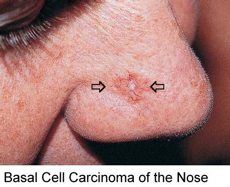 Diagnosis is based on clinical manifestations and history take a picture of the nasal cavity and paranasal sinuses. Radiation for Cancer of the Nose