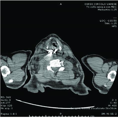 Preoperative Ct Scan Sagittal Download Scientific Diagram