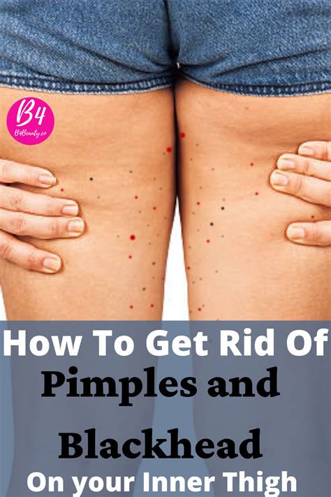 Why Do You Get Pimples And Blackheads On Inner Thighs In Inner