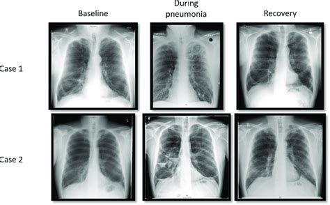 Chest Plain Radiographs For Both Cases Showing Pre During And