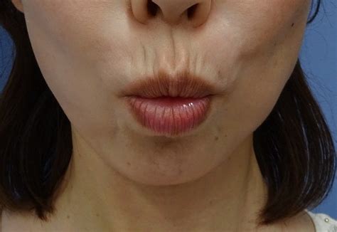 ベビーコラーゲンによる上口唇のタテじわ改善 15日後一例 Classy 仙台美容外科・美容皮膚科 ブログ