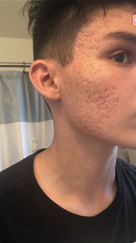 Severe Acne Scarring Scar Treatments