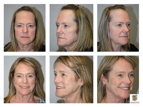Facial Cosmetic Surgery Before And After Photos