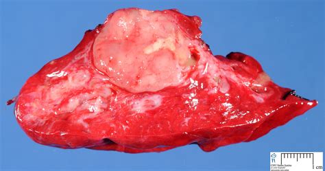 Pulmonary Carcinoid Tumor Human Pathology