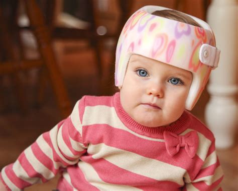 Kid Head Shaping Helmet Helmet Therapy For Your Baby Johns Hopkins