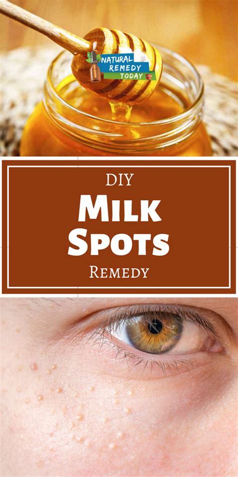 What Are The White Spots Under Your Eyes And How To Get Rid Of Them