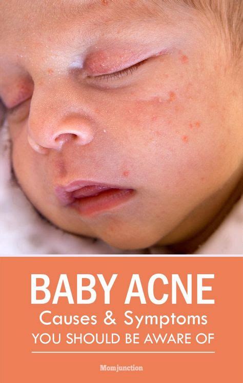 The 25 Best Baby Rash On Face Ideas On Pinterest Milk Rash Zinc