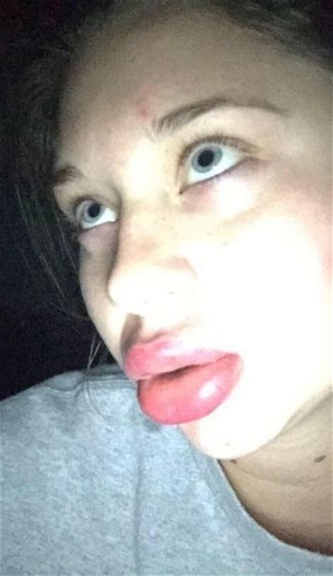 The Kylie Jenner Lip Challenge Has Turned Into A Complete Disaster 19 Pics