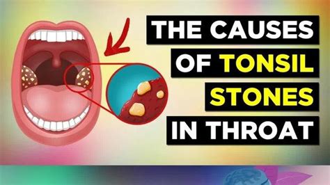 The Real Cause Of Tonsil Stones And Treatment