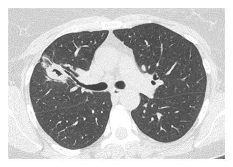 Ct Thorax Lung Window Axial View Showing The Cavitary Lesion In The