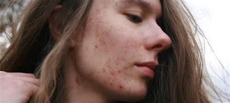 How To Get Rid Of Acne Redness