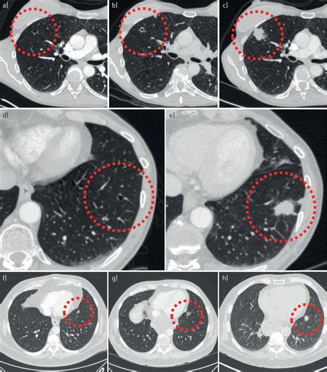 Cyst Related Primary Lung Malignancies An Important And Relatively