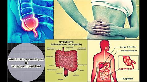Zapoznaj się z przykładami tłumaczeń 'blindedarmontsteking' w zdaniach, posłuchaj wymowy i przejrzyj gramatykę. Appendix Pain - Location, Symptoms, Treatment, Causes ...