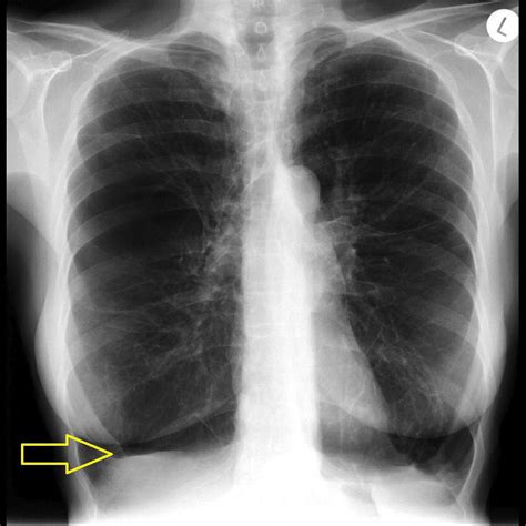 Radiograph Features In Emphysema Medizzy