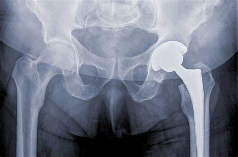 Hip and Elbow Replacement and Defective Product Suits - Scranton, PA