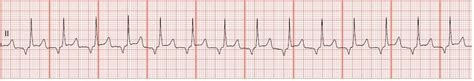 Float Nurse EKG Rhythm Strips 14 Junctional Rhythms