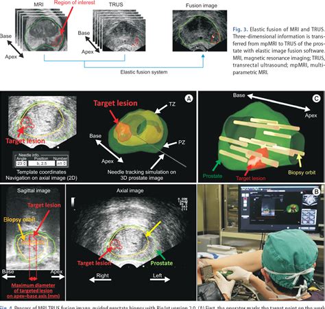 Pdf Magnetic Resonance Imaging Transrectal Ultrasound Fusion Image