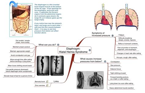 Mind Map Of Diaphragm Hiatal Hernia Syndrome