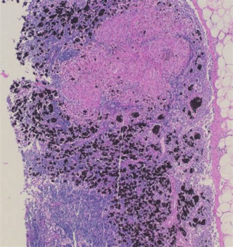 Lymph Node Showing Epithelioid Granulomas And Pigment Laden Macrophages