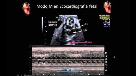 Ecocardiografía Fetal Ultrasonido En Modo M Para Evaluar El Corazón