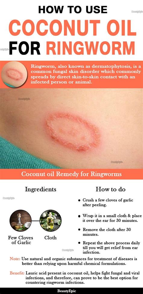 Ringworm How To Get It