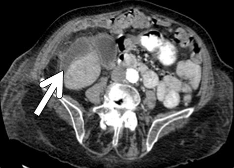 Acute Cholecystitis Preoperative Ct Can Help The Surgeon Consider