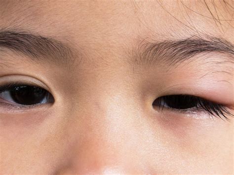 Swollen Eyes Hives Hives Urticaria And Angioedema Symptoms Causes
