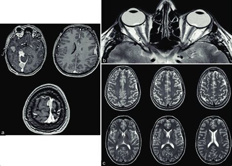 Gadolinium T1 Weighted Magnetic Resonance Imaging Images Showing