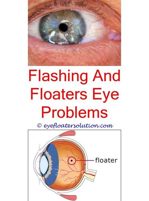 What Causes Flashing Lights In One Eye