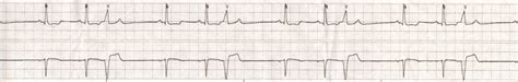 Ventricular Bi And Trigeminy Lost On The Floor