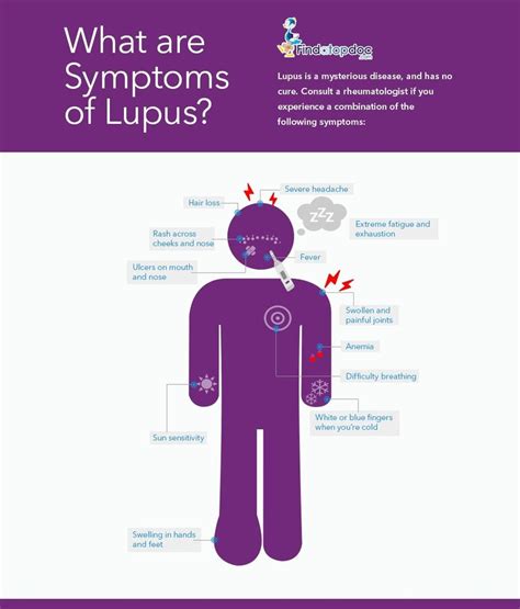 Lupus Symptoms Causes Treatment And Diagnosis Findatopdoc