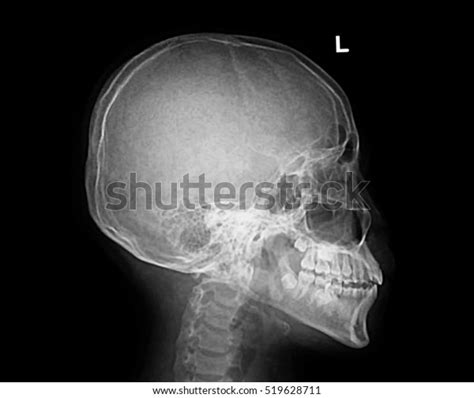 Check spelling or type a new query. Film Xray Skull Lateral Show Normal Stock Photo (Edit Now) 519628711