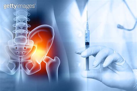 Injection For Hip Arthritis Hip Joint Injections 3d Illustration 이미지