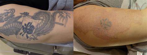 Discover 74 Picosure Tattoo Removal Before And After Latest Ineteachers
