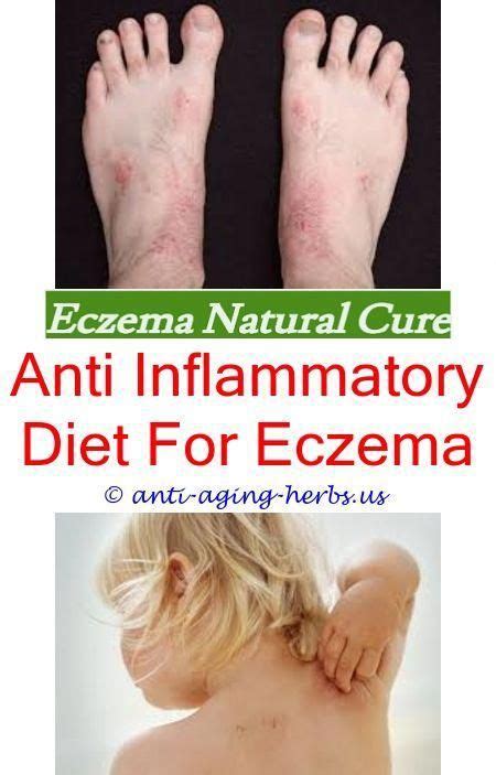 Almost Everyone Has Eczema Live Everyday Suffering But What Most
