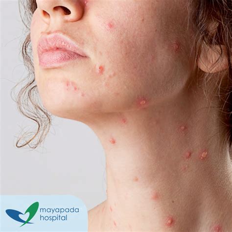Penyebab cacar air adalah virus varicella zoster yang menyerang kulit penderita. Mayapada Hospital | Anak Kena Cacar Air, Ini Yang Harus ...