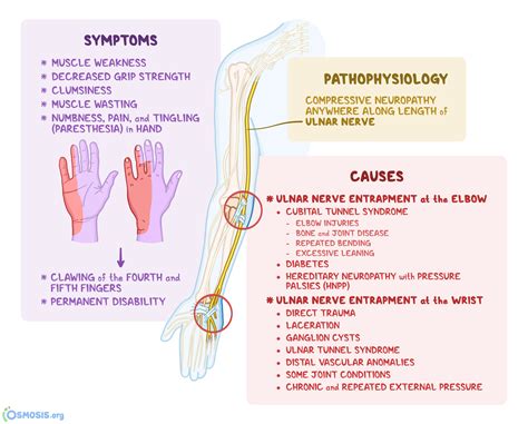 Nerve Entrapment, Injury and Neuropathy; Ulnar Nerve