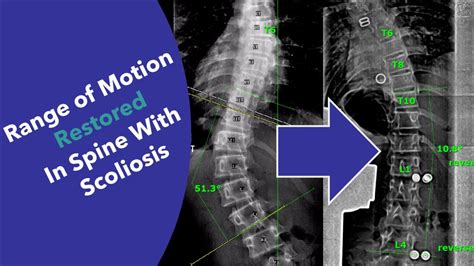 Amazing Device For Scoliosis Restores Range Of Motion And Improves