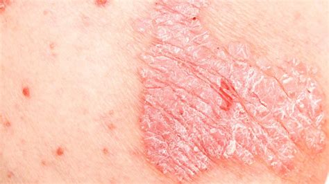 Hidradenitis Suppurativa Is It Contagious 2 Facts You Should Know
