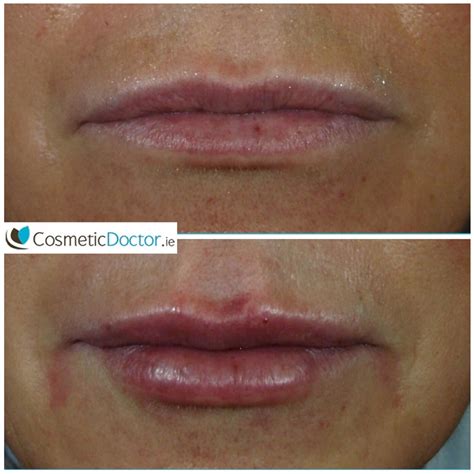 Beforeafterlipfillers3f16 Cosmetic Doctor Dublin Cosmetic