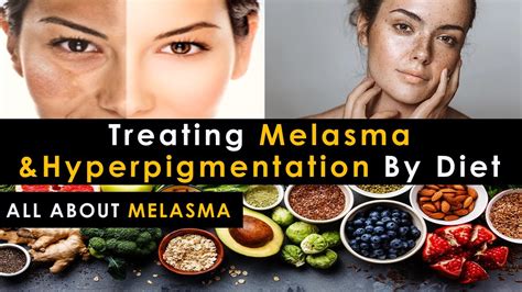 Melasma Cure Diet Treat Melasma And Hyperpigmentation By Diet Treat