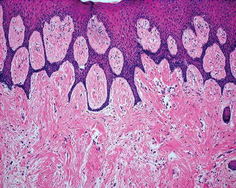 Gingival Hyperplasia Histology