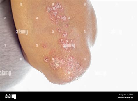 Psoriasis On Elbows Close Up Autoimmune Incurable Dermatological Skin