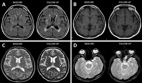 Neuroimaging Markers Of Cerebral Small Vessel Disease Panel A