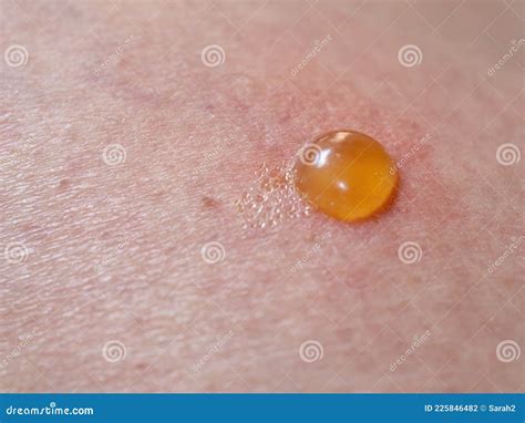 Insect Bite On Skin With Blister Stock Photo Image Of Dermatology