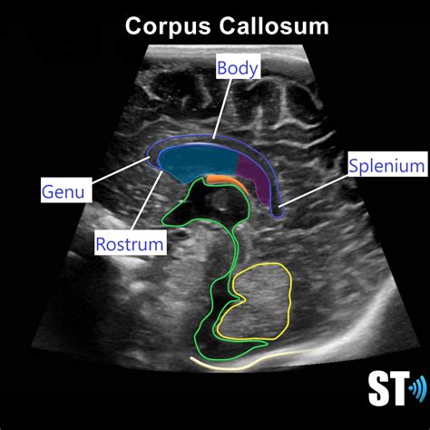 Neonatal Neurosonography Sonographic Tendencies