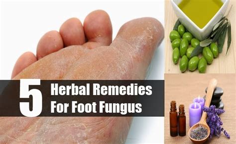 Top 5 Herbal Remedies For Foot Fungus Mzizi Mkavu