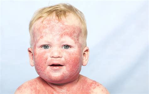 Dermatite Atopica Macchie Pelle Bambini Immagini Raccolta Di Immagini