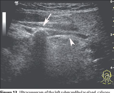 Figure 13 From Salivary Gland Calculi Contemporary Methods Of Imaging